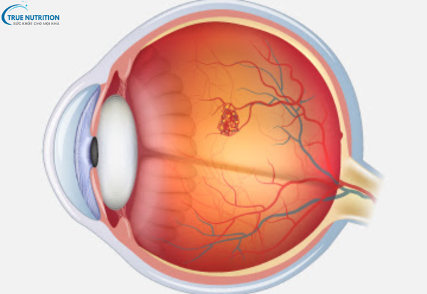 Dấu Hiệu Bệnh Thoái Hóa Điểm Vàng: Nhận Biết Sớm Để Bảo Vệ Thị Lực