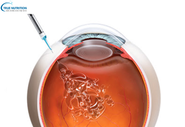 Dấu Hiệu Bệnh Thoái Hóa Điểm Vàng: Nhận Biết Sớm Để Bảo Vệ Thị Lực