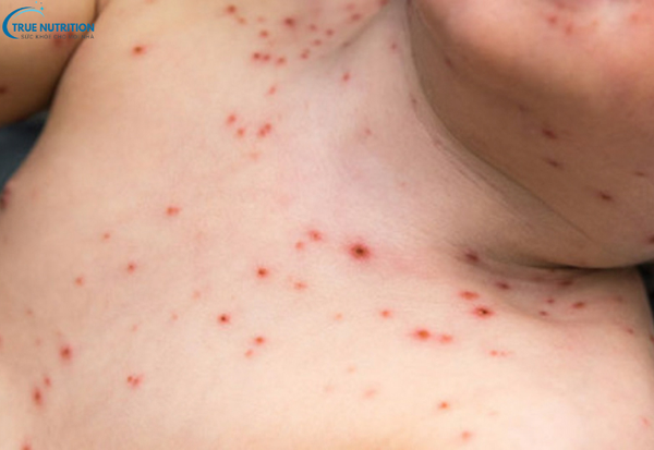 Dấu Hiệu Bệnh Thủy Đậu: Những Triệu Chứng Đặc Trưng Cần Lưu Ý