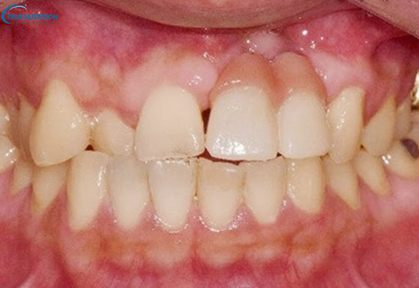 Bệnh U Nang Răng Là Gì? Nguyên Nhân, Dấu Hiệu Và Cách Phòng Ngừa