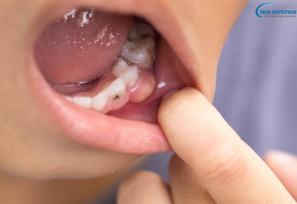 Bệnh U Nang Răng Là Gì? Nguyên Nhân, Dấu Hiệu Và Cách Phòng Ngừa