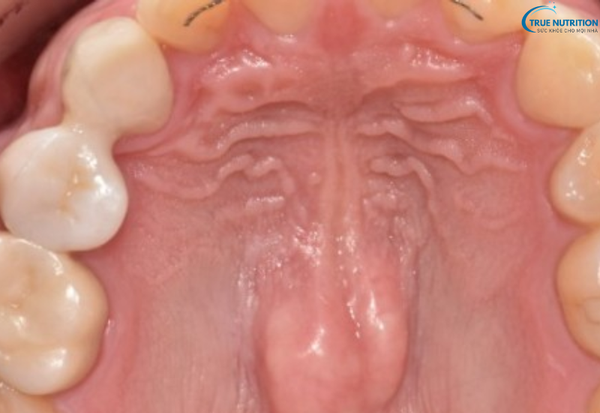 Bệnh U Nang Răng Là Gì? Nguyên Nhân, Dấu Hiệu Và Cách Phòng Ngừa
