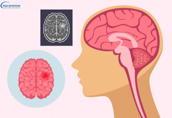 Dấu Hiệu Bệnh U Não: Những Triệu Chứng Cảnh Báo Bạn Không Thể Bỏ Qua