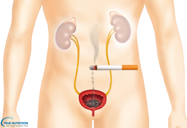 Dấu Hiệu Bệnh Ung Thư Bàng Quang : Cảnh Báo Từ Những Biểu Hiện Đầu Tiên