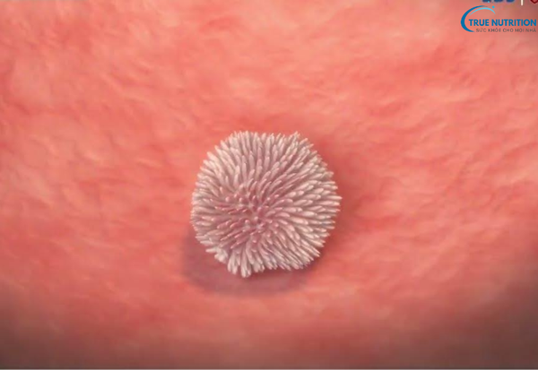 Dấu Hiệu Bệnh Ung Thư Bàng Quang : Cảnh Báo Từ Những Biểu Hiện Đầu Tiên