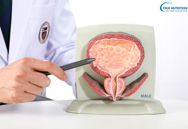 Dấu Hiệu Bệnh Ung Thư Bàng Quang : Cảnh Báo Từ Những Biểu Hiện Đầu Tiên