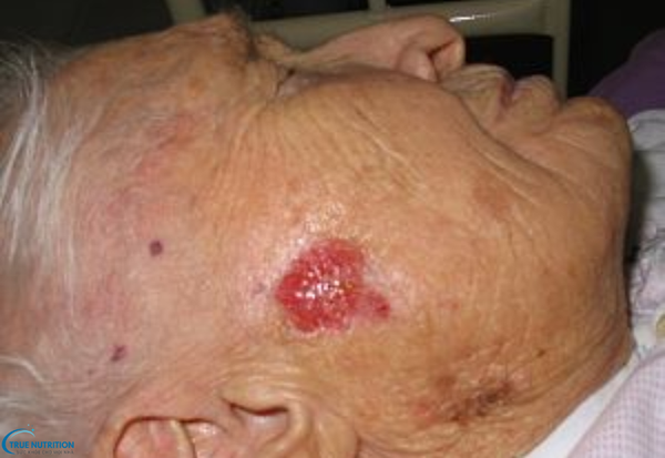 Dấu hiệu bệnh ung thư da: Nhận biết sớm để bảo vệ sức khỏe của bạn