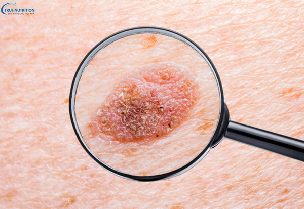 Dấu hiệu bệnh ung thư da: Nhận biết sớm để bảo vệ sức khỏe của bạn