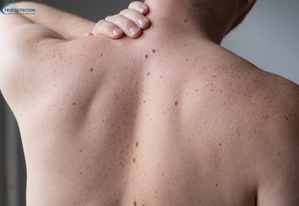 Dấu hiệu bệnh ung thư da: Nhận biết sớm để bảo vệ sức khỏe của bạn