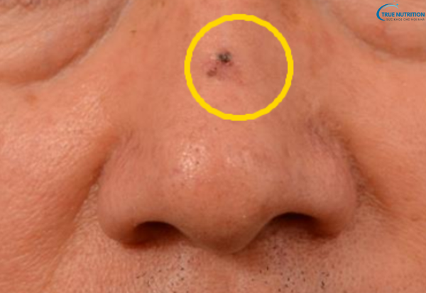 Dấu hiệu bệnh ung thư da: Nhận biết sớm để bảo vệ sức khỏe của bạn