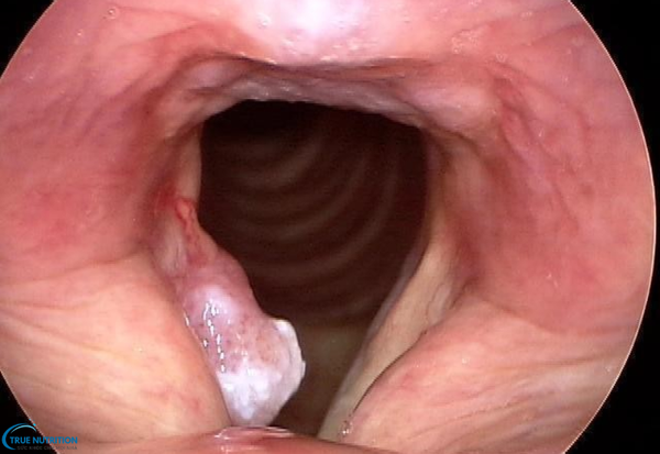 Triệu Chứng Của Bệnh Ung Thư Thanh Quản: Những Dấu Hiệu Bạn Cần Biết