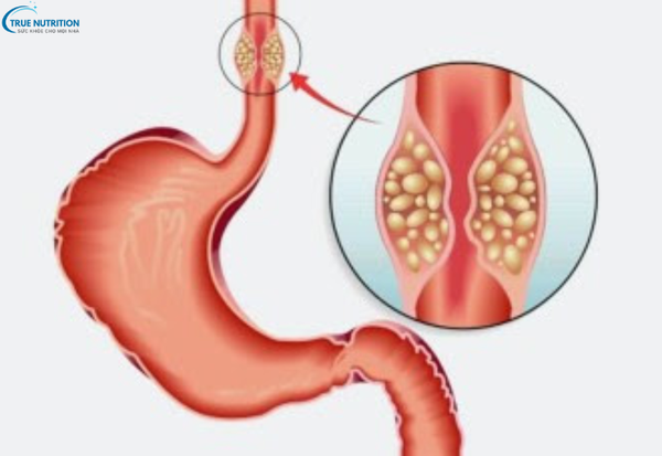 Triệu Chứng Bệnh Ung Thư Thực Quản: Nhận Biết Sớm Để Điều Trị Kịp Thời