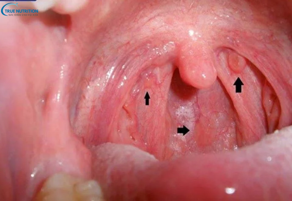 Triệu Chứng Bệnh Ung Thư Vòm Họng: Dấu Hiệu Cảnh Báo Cần Chú Ý Sớm