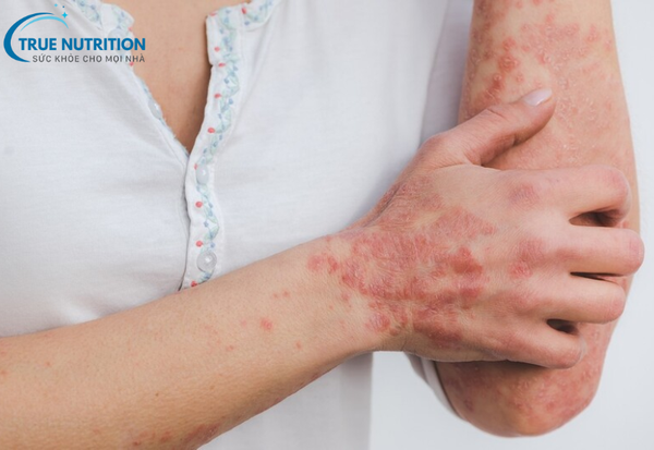 Bệnh Vảy Nến Là Gì? Cách Kiểm Soát Và Phòng Ngừa Hiệu Quả Nhất