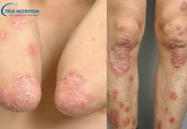 Bệnh Vảy Nến Là Gì? Cách Kiểm Soát Và Phòng Ngừa Hiệu Quả Nhất