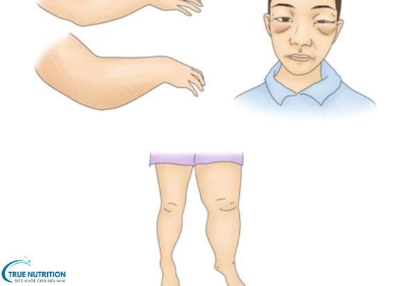 Bệnh Viêm Cầu Thận: Hiểu Đúng Bệnh Lý Và Giải Pháp Điều Trị Hiệu Quả