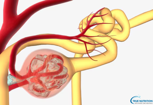 Bệnh Viêm Cầu Thận: Hiểu Đúng Bệnh Lý Và Giải Pháp Điều Trị Hiệu Quả