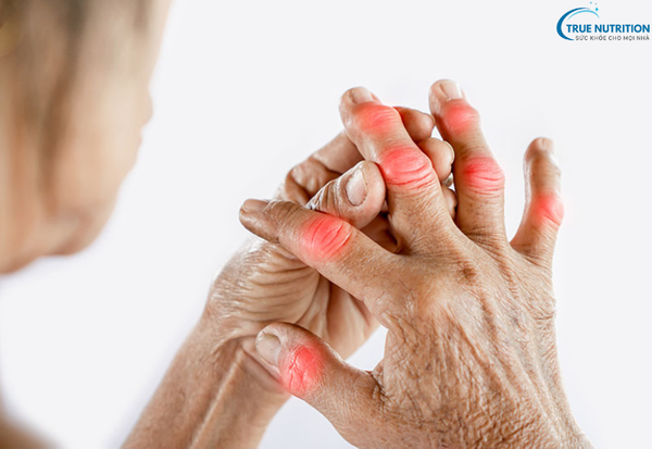 Triệu Chứng Viêm Khớp Dạng Thấp: Những Biểu Hiện Để Điều Trị Kịp Thời