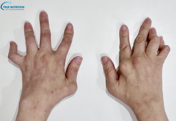 Triệu Chứng Viêm Khớp Dạng Thấp: Những Biểu Hiện Để Điều Trị Kịp Thời