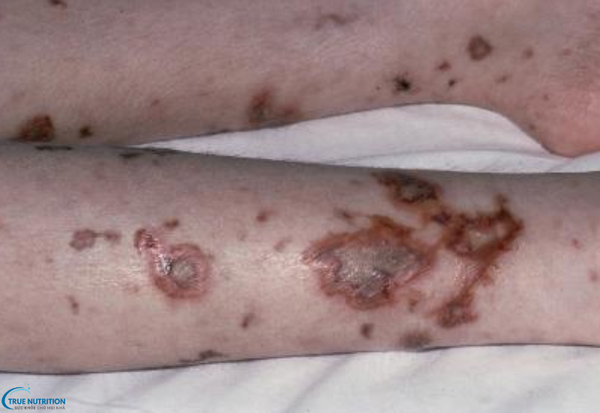 Phòng Bệnh Viêm Màng Não Mô Cầu: BÍ Quyết Bảo Vệ Sức Khỏe Gia Đình Bạn