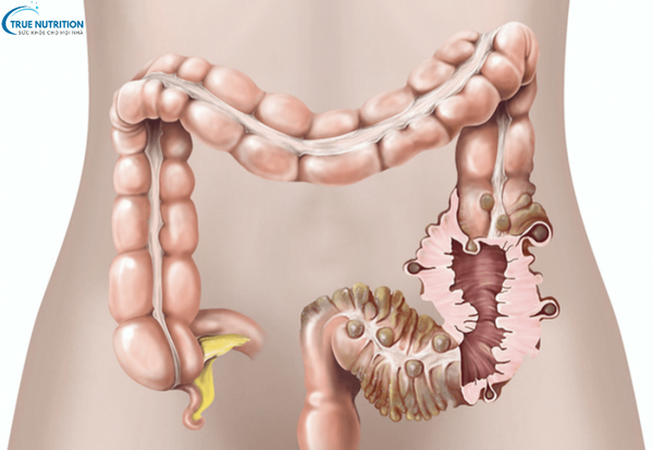 Bệnh viêm túi thừa là gì? Triệu chứng nhận biết và cách điều trị