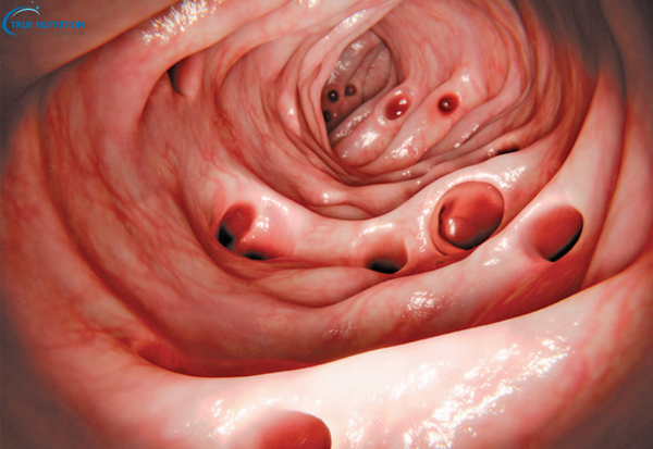 Bệnh viêm túi thừa là gì? Triệu chứng nhận biết và cách điều trị