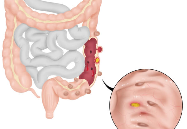 Bệnh viêm túi thừa là gì? Triệu chứng nhận biết và cách điều trị