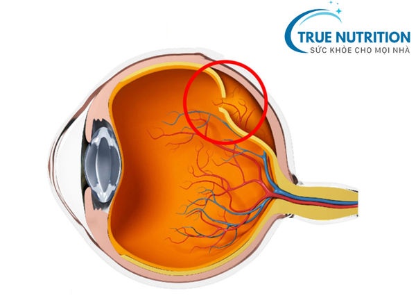 Bệnh Võng Mạc Tiểu Đường