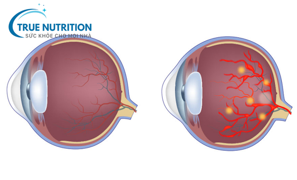 Bệnh Võng Mạc Tiểu Đường
