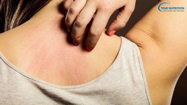 Bị Gan Có Ngứa Không?