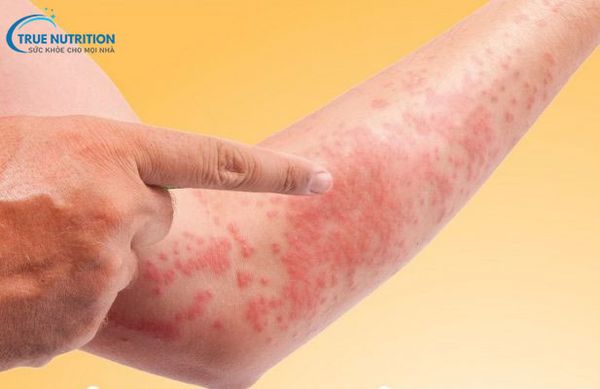 Bị Gan Có Ngứa Không?