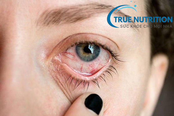 Biến Chứng Tiểu Đường Lên Mắt