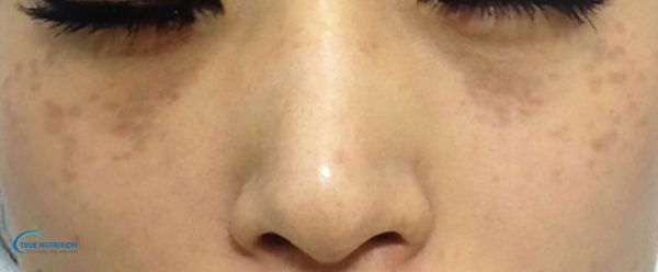 Bớt Hori Là Gì, Có Chữa Được Không, Xuất Hiện Ở Độ Tuổi Nào?