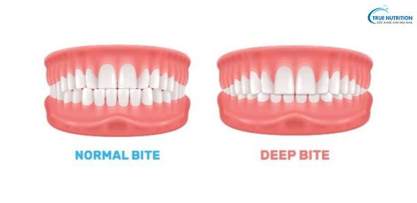 Khớp Cắn Chuẩn Cách Xác Định - Nhìn Nghiêng Khớp Cắn Chuẩn