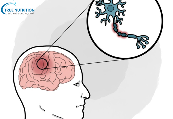 Bệnh Đa Xơ Cứng Là Gì? Chi Tiết Về Bệnh MS và Cách Quản Lý Sức Khỏe