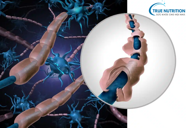 Bệnh Đa Xơ Cứng Là Gì? Chi Tiết Về Bệnh MS và Cách Quản Lý Sức Khỏe