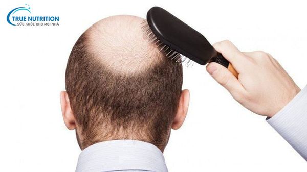 Lăn Kim Mọc Tóc Là Gì? Có Đau Không? Bao Lâu Thì Có Hiệu Quả?