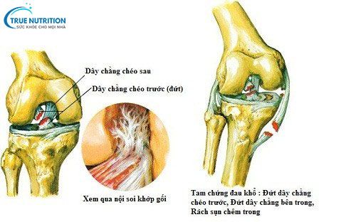 10 Điều Tránh Sau Mổ Dây Chằng Chéo: AN Toàn & Mau Lành