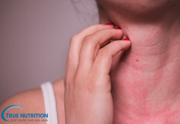 Dị Ứng Thời Tiết: Bí Quyết Phòng Ngừa Và Giảm Nhẹ Triệu Chứng