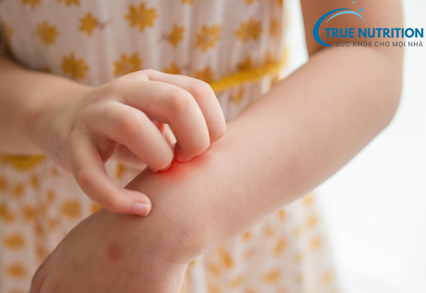 Dị Ứng Thời Tiết: Bí Quyết Phòng Ngừa Và Giảm Nhẹ Triệu Chứng