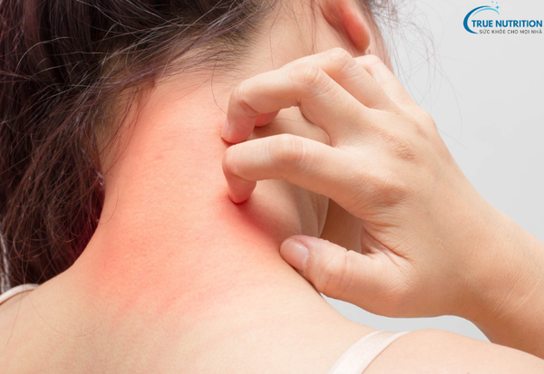 Cách Điều Trị Bệnh Dị Ứng Thuốc, Phương Pháp và Lời Khuyên Cần Biết