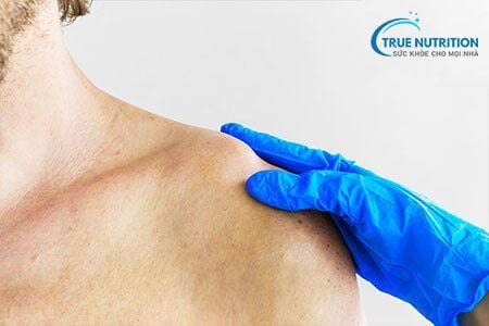 Tư Thế Nằm Ngủ Khi Bị Gãy Xương Đòn Đúng Chuẩn Để Không Gây Di Chứng