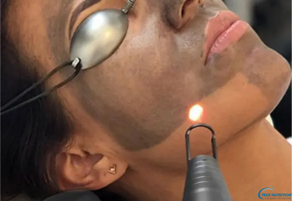 Laser Pico Là Gì? Tìm Hiểu Công Nghệ Điều Trị Da Mới Nhất Dành Cho Bạn