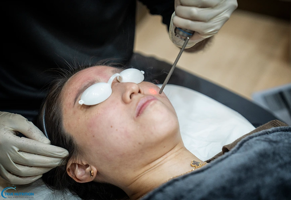 Laser Pico Là Gì? Tìm Hiểu Công Nghệ Điều Trị Da Mới Nhất Dành Cho Bạn