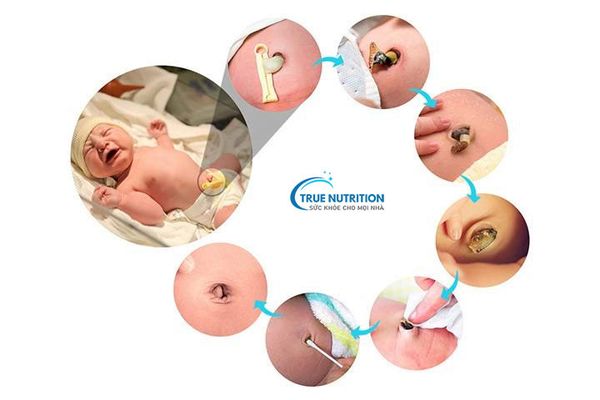 Tồn tại nang ống niệu rốn ở trẻ sơ sinh là gì? Bao giờ cần mổ?