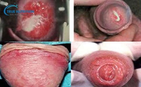 Nhận Diện Hình Ảnh Bệnh Lậu Giai Đoạn Đầu. Khác Biệt Giữa Nam & Nữ