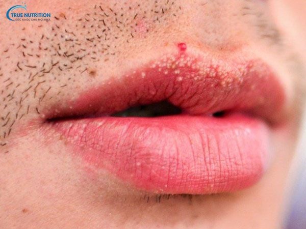 Cách Chữa Nổi Hạt Fordyce Trên Môi: Mẹo, Công Nghệ, Sinh Hoạt