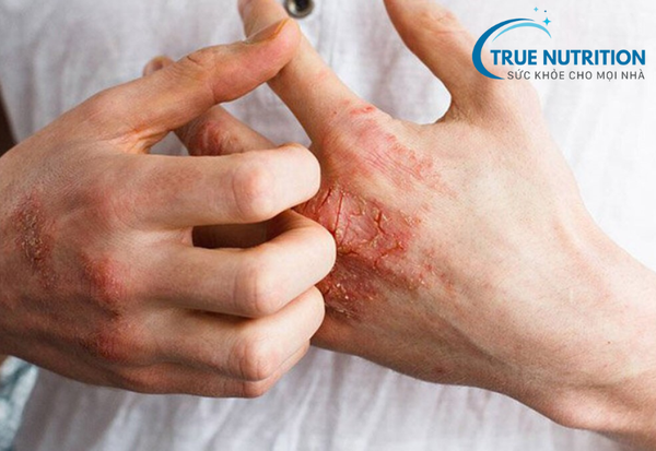 Giang Mai: Bệnh Lây Truyền Qua Đường Tình Dục Cần Cảnh Giác