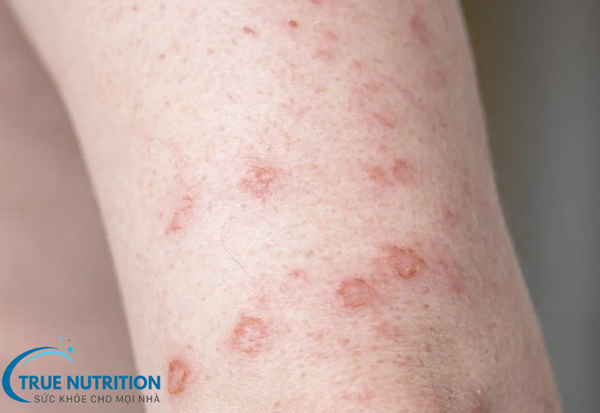 Giang Mai: Bệnh Lây Truyền Qua Đường Tình Dục Cần Cảnh Giác