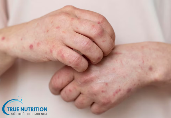 Giang Mai: Bệnh Lây Truyền Qua Đường Tình Dục Cần Cảnh Giác